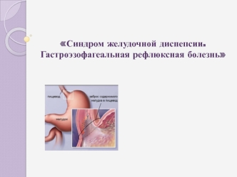 Синдром желудочной диспепсии. Гастроэзофагеальная рефлюксная болезнь