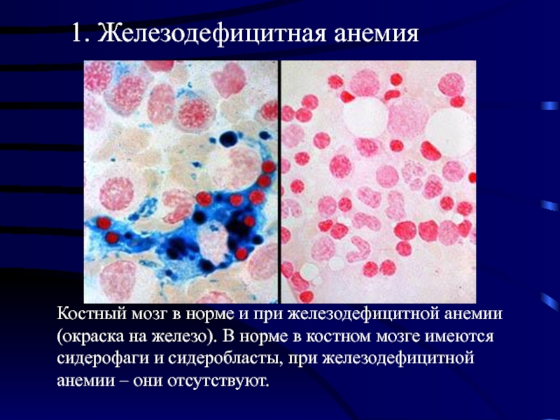 Нормальная картина пунктата костного мозга при подозрении на множественную миелому