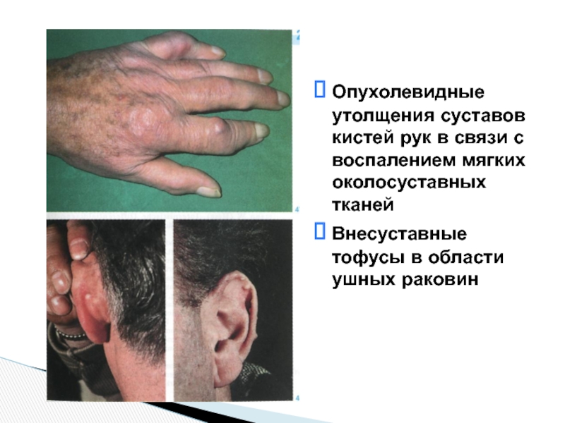 Опухолевидные утолщения суставов кистей рук в связи с воспалением мягких околосуставных тканей Внесуставные тофусы в области
