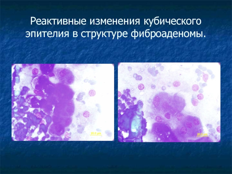 Клетки метаплазированного эпителия с реактивными изменениями. Дисплазия кубического эпителия. Реактивные изменения клеток плоского и цилиндрического эпителия. Реактивные изменения эпителия что это такое. Реактивные изменения эпителия цитология.