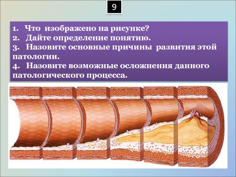 Назовите возможные причины. Организация это процесс в патологии. Причины инкапсуляции в патологии. Стадии инкапсуляции в патологии. Презентации по основам патологии.