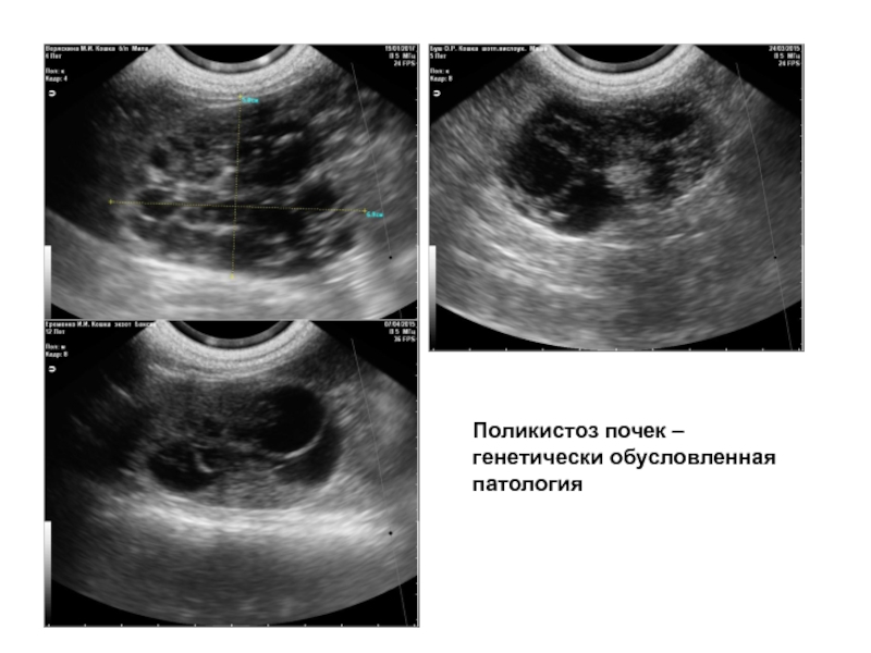 Как выглядит поликистоз яичников фото