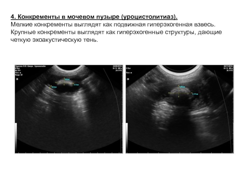 Гиперэхогенная взвесь в мочевом