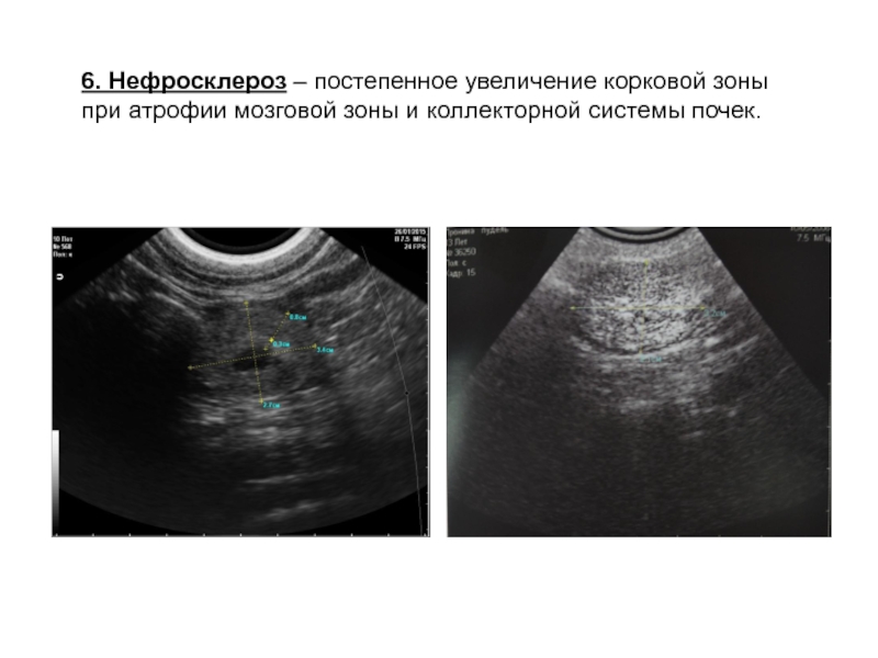 Постепенное увеличение. Нефросклероз УЗИ заключение. Нефросклероз почек на УЗИ что это такое. Нефросклероз почек УЗИ протокол. Нефросклероз УЗИ признаки.