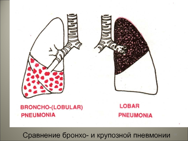 Крупозная пневмония рисунок