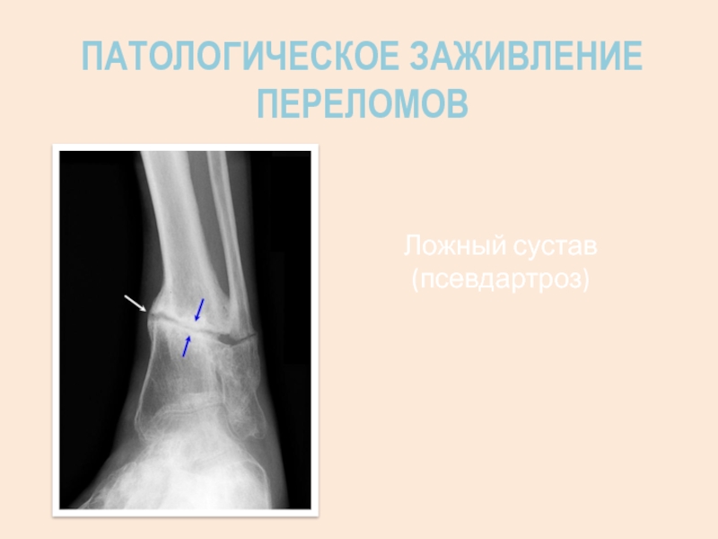 Сроки заживление переломов костей