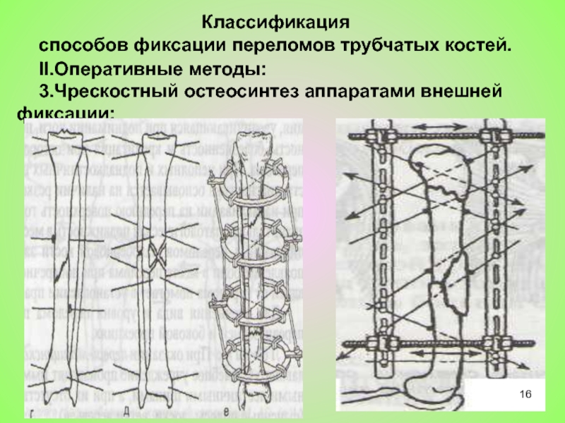 Наружным способом. Погружной чрескостный остеосинтез. Чрескостный остеосинтез классификация. Внешний фиксатор Тип 1 остеосинтез. Погружной остеосинтез классификация.