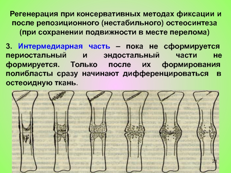 Эндостальная мозоль. Периостальные переломы это. Интермедиарный перелом. Периостальные наложения схема.