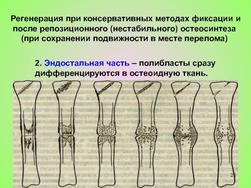 2 регенерация. Эндостальная костная мозоль. Регенерация кости при переломе. Регенерация костной ткани при переломах. Регенерация костей после переломов.