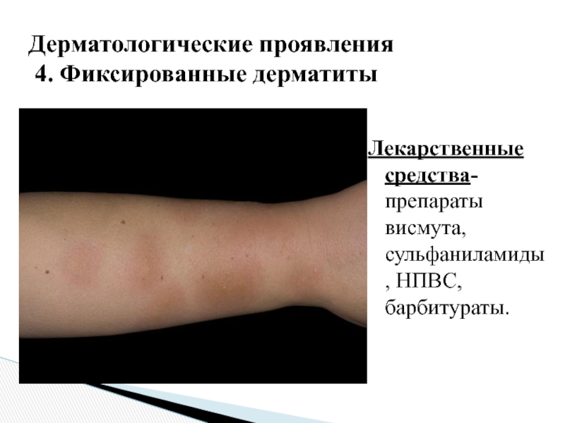 Лекарственная аллергия презентация, доклад