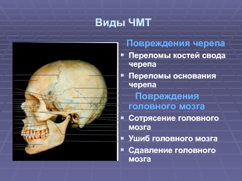 Свод черепа это где фото