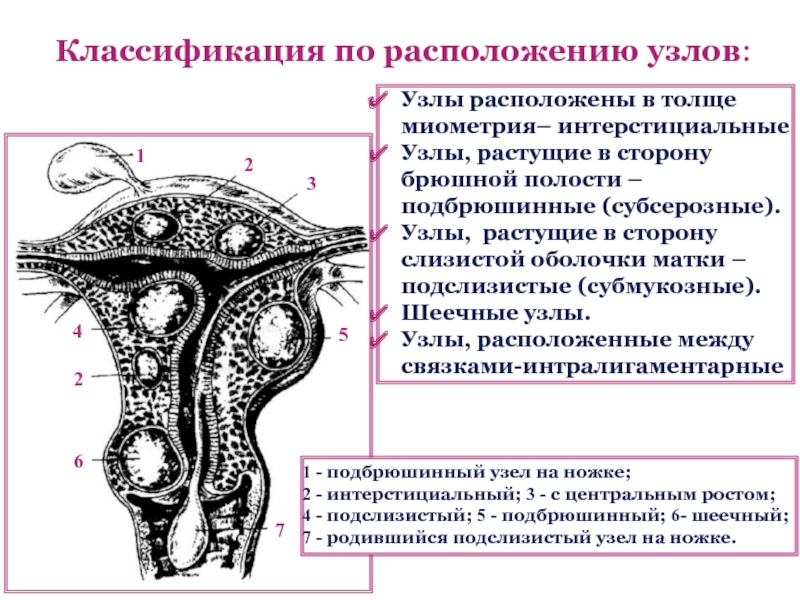 Миометрия что это такое у женщин