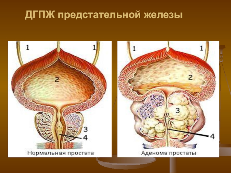 Увеличение предстательной железы у мужчин причины