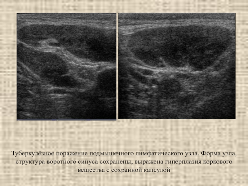 Эхографической картиной характеризующей липоматозный узел является