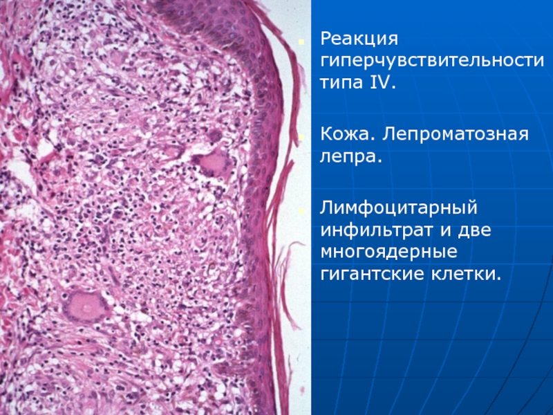 Лимфоцитарная инфильтрация что это