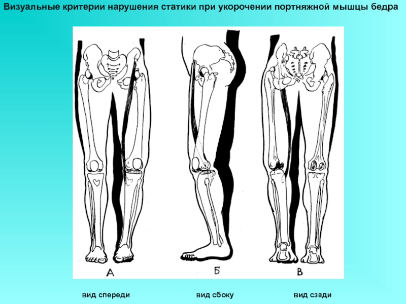 Нарушение статики. Мышцы ног укорочение. Виды укорочения конечностей. Мышцы нижних конечностей портняжная мышца. Массаж портняжной мышцы бедра.