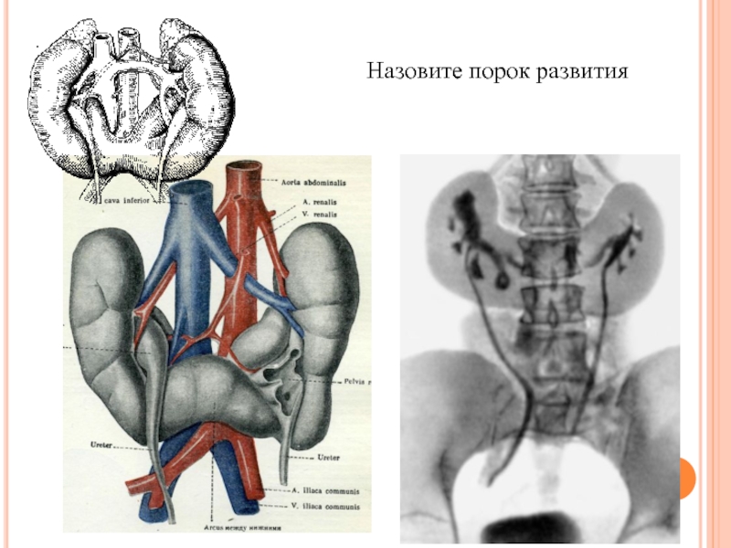 Аномалия развития почек презентация