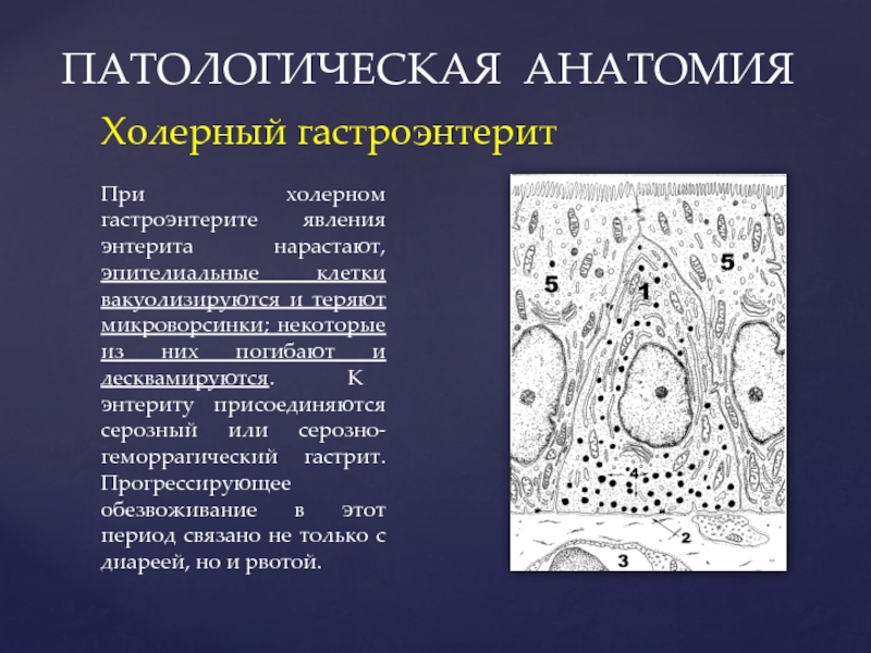 Патологическая анатомия презентации. Холера патологическая анатомия презентация. Холерный гастроэнтерит. Энтерит патологическая анатомия. Холерный энтерит, гастроэнтерит.