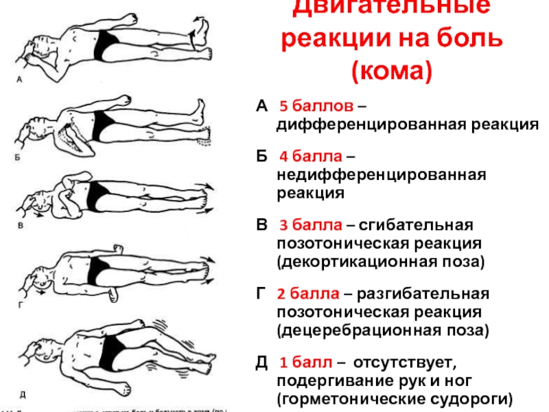 Ответ на боль. Декортикационная ригидность. Двигательная реакция на боль. Декортикационная и децеребрационная ригидность. Декортикационная ригидность возникает при поражении.