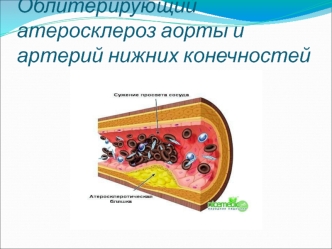 Облитерирующий атеросклероз аорты и артерий нижних конечностей