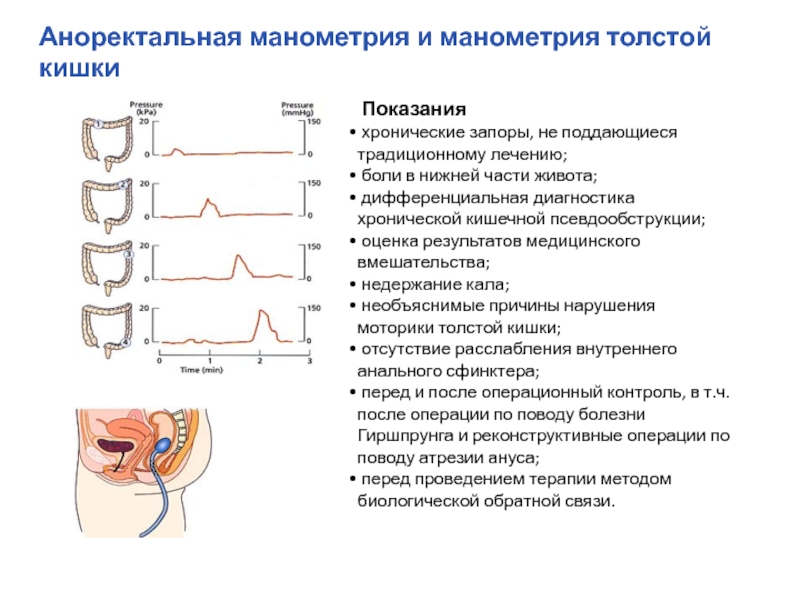 Ректоцеле прямой кишки фото