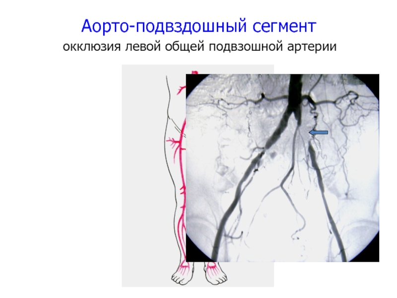 Тромбоз подвздошных вен. Поверхностная бедренная артерия окклюзия. Ангиограмма подвздошных артерий. Окклюзия вен нижних конечностей. Стеноз бедренной артерии.
