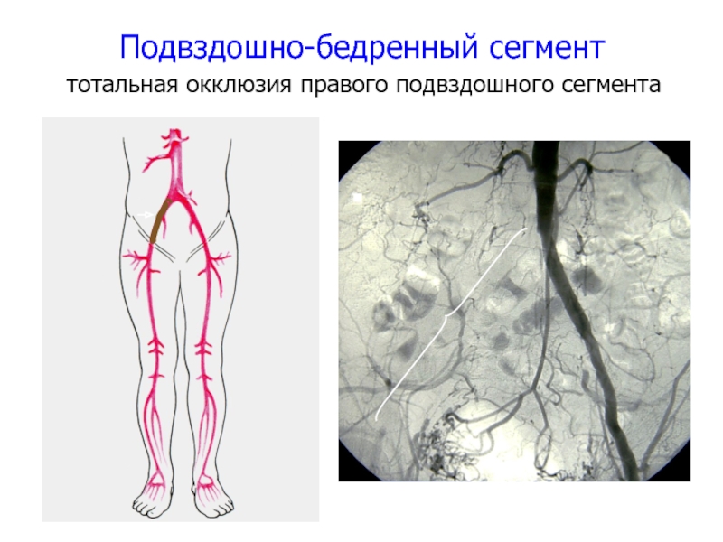 Тромбоз подвздошных вен. Бедренно-подколенный венозный тромбоз. Тромбоз наружной подвздошной вены. Тромбоз подвздошно бедренного сегмента. Тромбоз подвздошной вены на УЗИ.