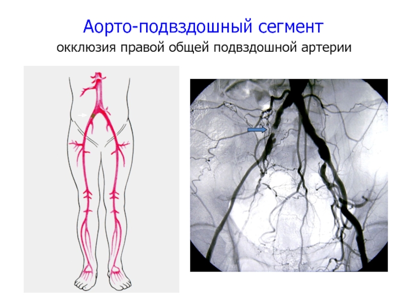 Правая подвздошная артерия. Аневризматическое расширение подвздошная артерия. Схема аневризма подвздошной артерии. Аневризма бедренной артерии. Аневризма общей подвздошной артерии на УЗИ.