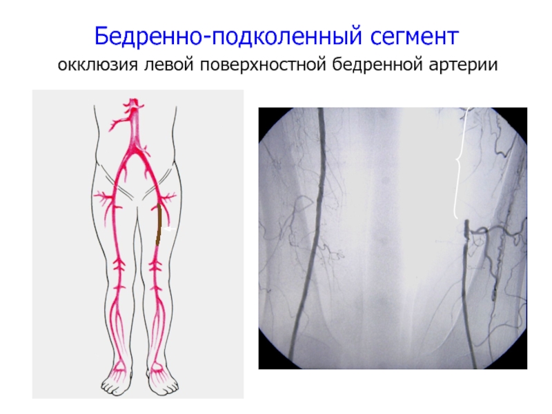 Операция на артерии нижних конечностей. Тромбоз бедренно подколенного шунта. Подвздошно бедренный тромбоз. Поверхностная бедренная артерия окклюзия. ПБА поверхностная бедренная артерия.