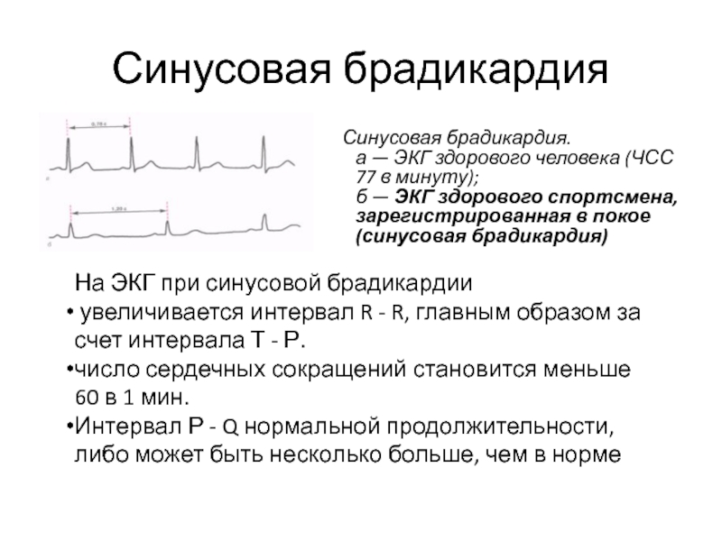 Что такое брадикардия. Синусовая брадикардия на ЭКГ. Минусовая браликарлия ЭКГ. Синусовая брадикардия ЭКГ проявления. ЭКГ при синусовой брадикардии.