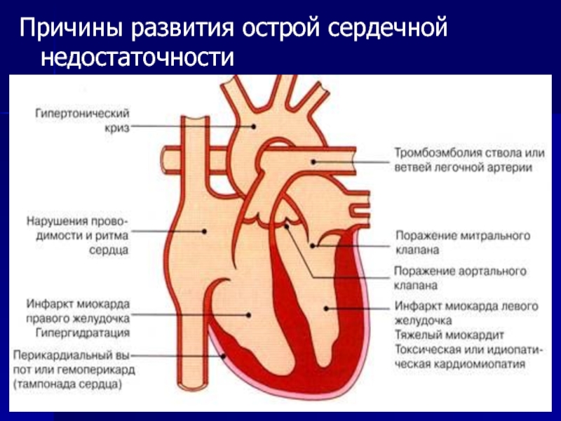 Острое сердце. Причины развития острой сердечной недостаточности. Острая сосудистая недостаточность презентация. Тампонада сердца острая сердечная недостаточность. Острая сердечная недостаточность тромбоэмболия.