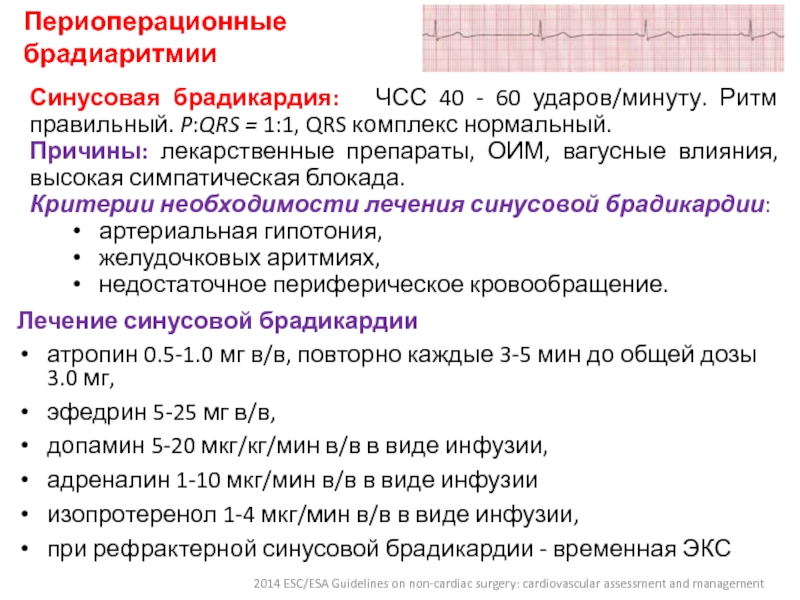 Как лечить брадикардию сердца