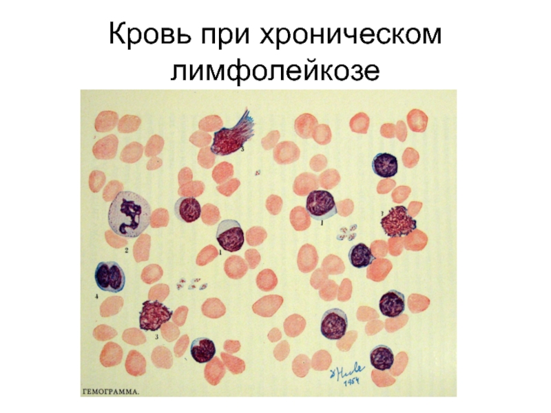 Кровь при хроническом лимфолейкозе