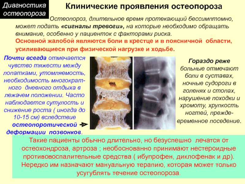 Стадии остеопороза