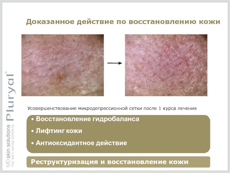 Доказанное действие по восстановлению кожи Усовершенствование микродепрессионной сетки после 1 курса лечения