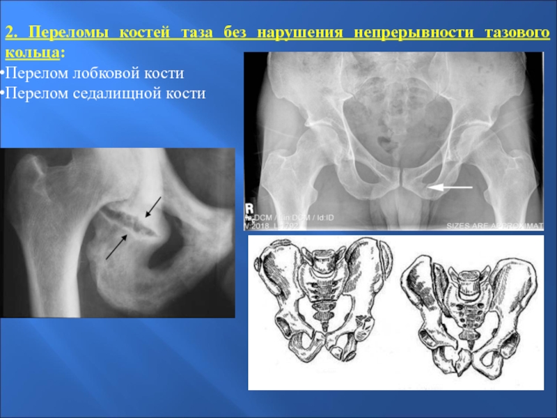 Переломы костей таза презентация