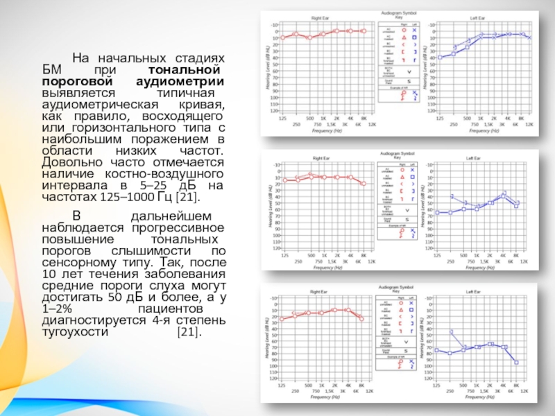 Проверка слуха аудиометрия. Тональная пороговая аудиометрия при тугоухости. Тональная пороговая аудиометрия норма. Тональная пороговая аудиометрия при болезни Меньера. Тональная пороговая аудиометрия заключение.