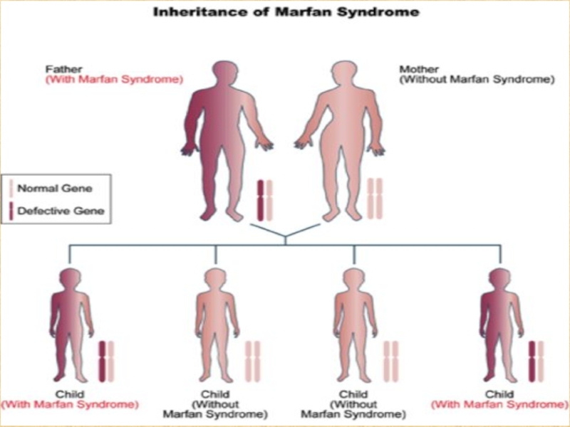Реферат: Синдром Марфана 2
