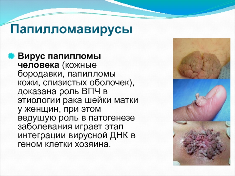 Папилломавирусы Вирус папилломы человека (кожные бородавки, папилломы кожи, слизистых оболочек), доказана
