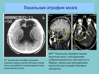 Локальная атрофия мозга