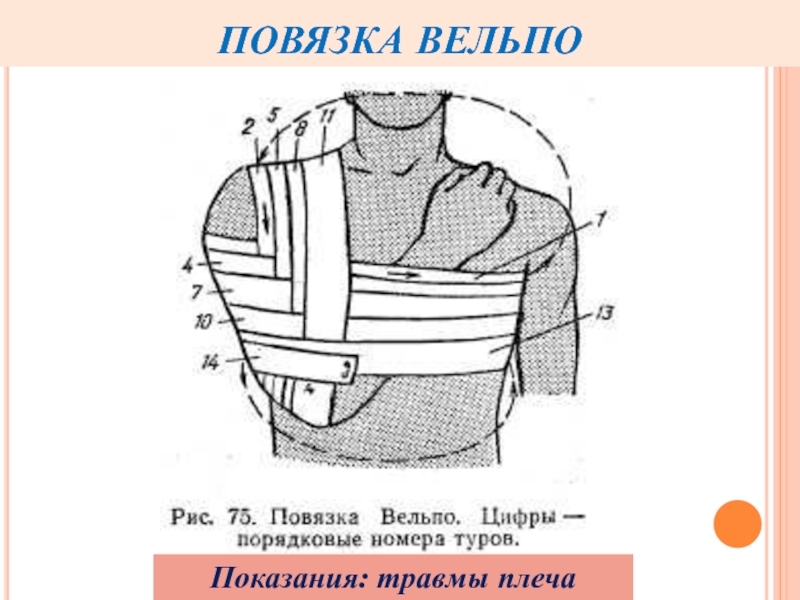 Дезо повязка на плечевой схема