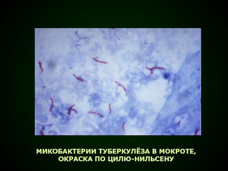 Микобактерии туберкулеза в мокроте