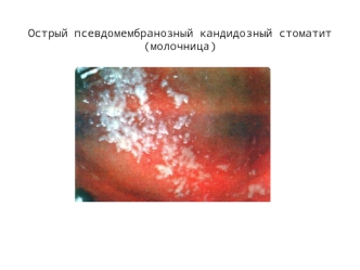 Острый псевдомембранозный кандидозный стоматит (молочница)