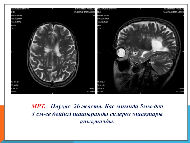 Шашыранды склероз презентация