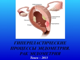 Гиперпластические процессы эндометрия. Рак эндометрия