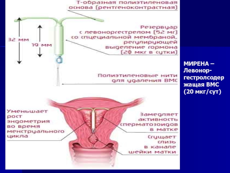 Гиперпластические процессы эндометрия. Рак эндометрия презентация, доклад