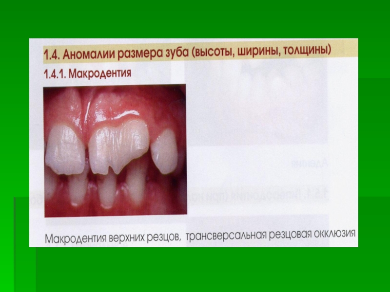 Реферат: Aномалии зубочелюстной системы