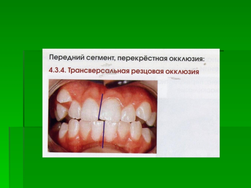 Реферат: Aномалии зубочелюстной системы