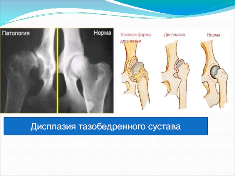 Презентация дисплазия тазобедренных суставов