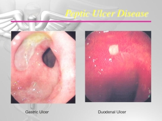 Peptic ulcer disease